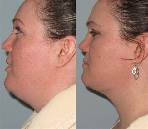 Chin Lipo Before And After