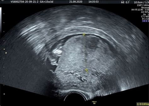 Transvaginal Ultrasound Examination At 16 Weeks Of Gestation Note The