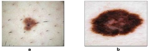 Sample Dermoscopic Images A Benign Skin Lesion And B Malignant