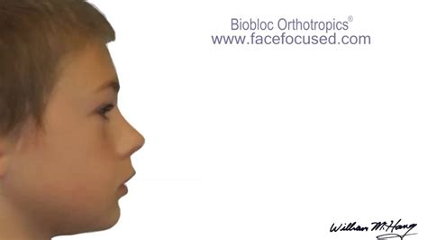 Dr Hangs Biobloc Orthotropic Treatment Morph Youtube