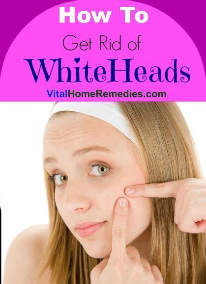 How To Get Rid Of Whiteheads Vital Home Remedies