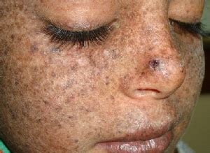 Dalam ruangan terbuka, banyak jenis debu, virus. 70 Jenis Penyakit Kulit, Beserta Gambarnya