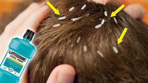 Get Rid Of Head Lice With Only One Ingredient Youtube