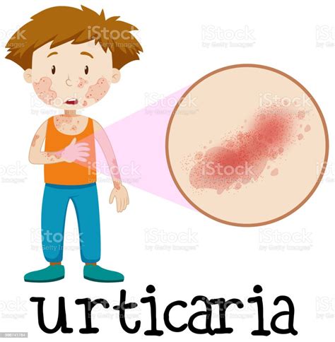 A Vector Of Skin Urticaria Stock Illustration Download Image Now Istock