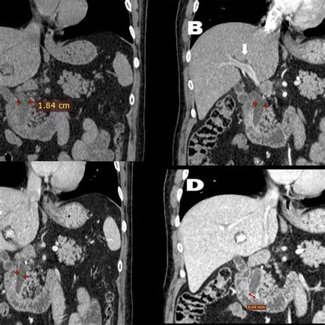 Quadruple Phase Computed Tomography A Pre Contrast B Arterial
