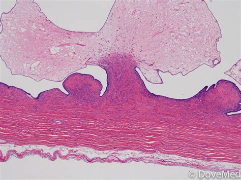 Benign Mucinous Cystadenofibroma Of Ovary
