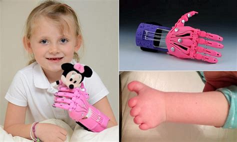 hayley fraser born without fingers is first to receive bionic iron man style hand daily mail