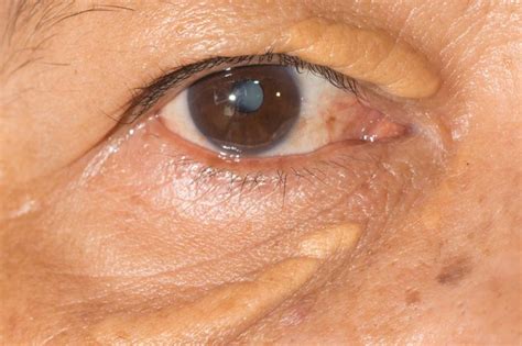 Xanthelasma Removal Get Rid Of Cholesterol Deposits The Healthy