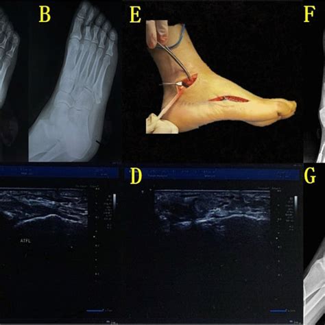 A B Preoperative Foot Radiographs Showed Displaced Fifth Metatarsal Download Scientific