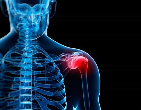 Shoulder anatomy shoulder injuries chicago westchester. Bursitis: Causes, Symptoms and Treatments - Medical News Today