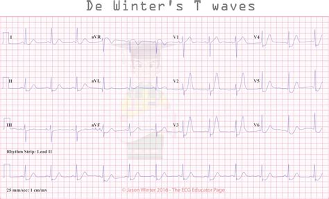 First identified in 2008 by dr. ECG Educator Blog : De Winters T waves