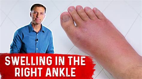 What Causes Right Ankle Edema Youtube