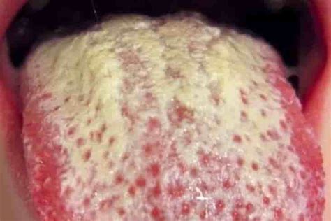 The surface may also be completely covered by a white stuff. White Spots on Tongue, Tip, Side, Under, Back, Dots ...
