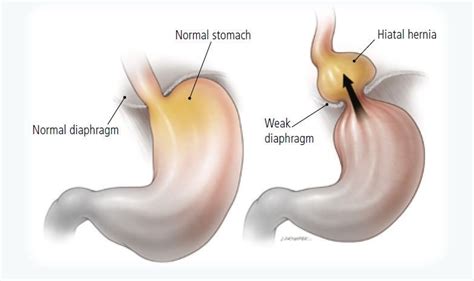 gastroesophageal reflux disease gerd guide causes symptoms and treatment options