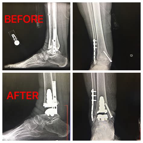 Total Ankle Replacement Before And After The Orthopaedic Group Pc
