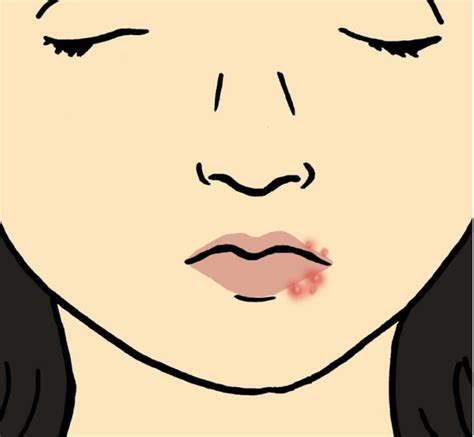 Everything About Cold Sores What Are They What Causes Them And How