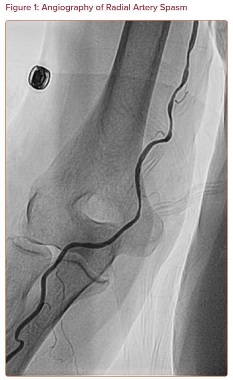 Angiography Of Radial Artery Spasm Radcliffe Cardiology