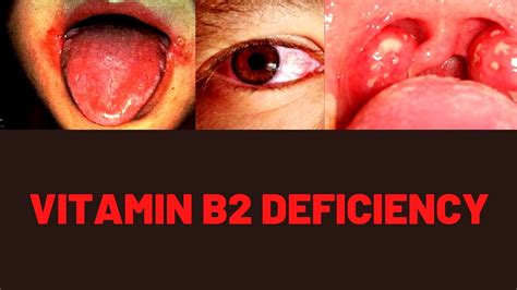 Vitamin B2 Benefits Food Sources Deficiency Symptoms Youtube