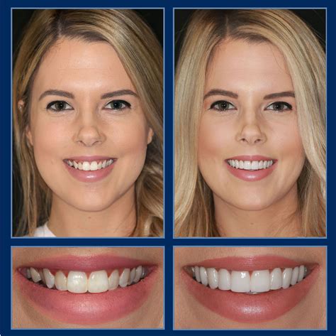Get A Beautiful New Smile In Just 2 Visits 2500 Off A Smile Makeover Call 5123337777 For A