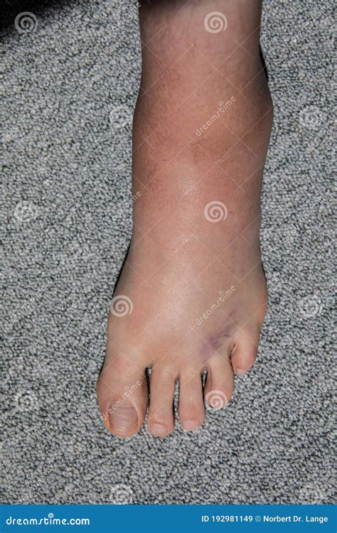Severe Swelling And Hematoma Of The Left Foot Stock Image