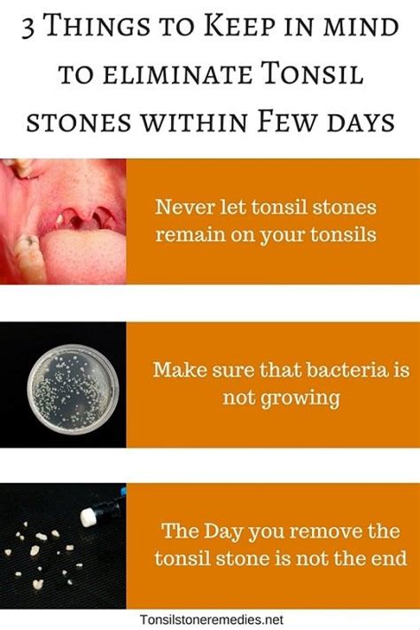 How Long Do Tonsil Stones Last Days Weeks Or Years