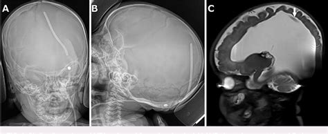 Figure 1 From Distal Ventriculoperitoneal Shunt Catheter Tightly Coiled