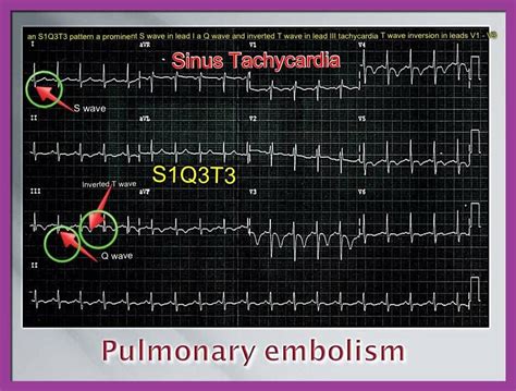 ECG Study Cards Sinus Tachycardia Pulmonary Embolism Pulmonary
