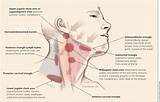 Lymph Nodes Sore On One Side Of Neck