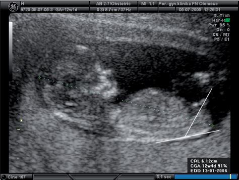 14 Weeks Pregnant Ultrasound Gender