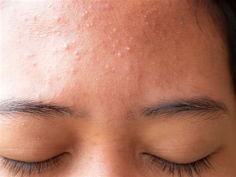 How To Get Rid Of Small Bumps On Your Forehead Zitsticka Uk