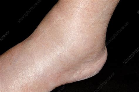 Ankle Swelling After Amlodipine Drug Stock Image C0135870