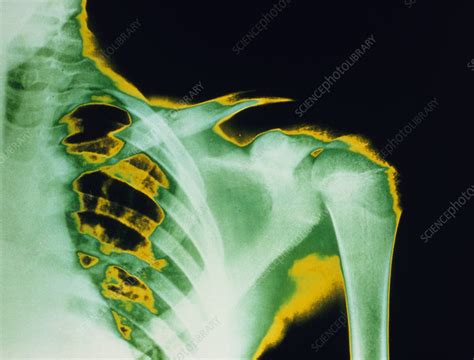 False Col X Ray Of Simple Fracture Of Collar Bone Stock Image M330