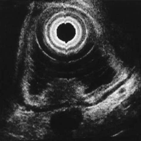 Endoscopic Ultrasound Eus Finding Demonstrating That The Tumor Has Download Scientific