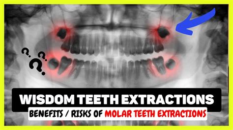 Wisdom Teeth Extraction Procedure Removal Cost Pain Dry Socket