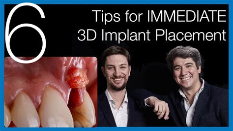 🇺🇸 Immediate Dental Implant Placement 6 Tips For Success Implantology Talks Youtube