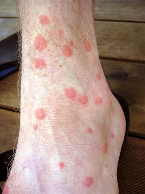 Mosquito Bites Treatment Of The Itch