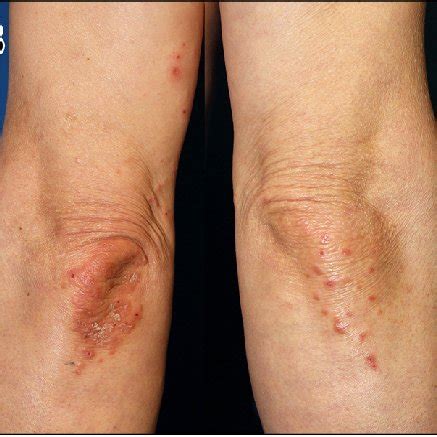 Intensely Pruritic Erythematous And Scaly Papules And Plaques A Download Scientific Diagram