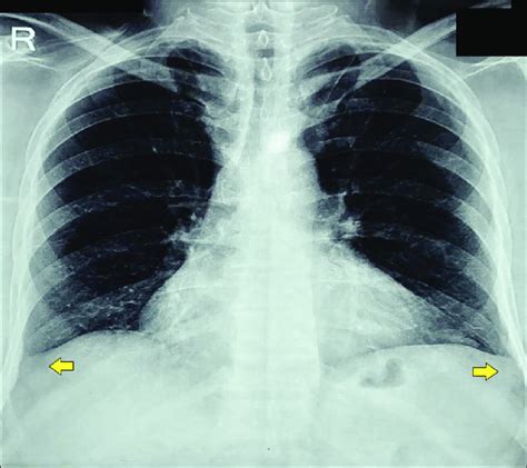 Chest X Ray Demonstrating Bilateral Clear Lung Fields And Blunting Of