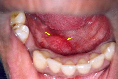 Pull your tongue out gently with clean fingers and inspect underneath. Cancer Of Saliva Gland - Teroes