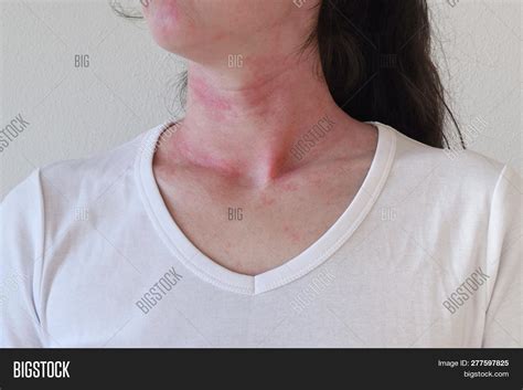 Allergic Skin Reaction Image And Photo Free Trial Bigstock