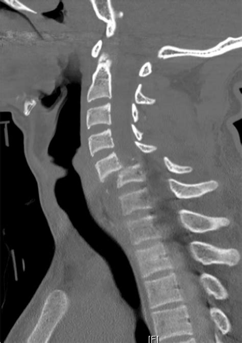 Subaxial Cervical Spine Ct Radiology Key