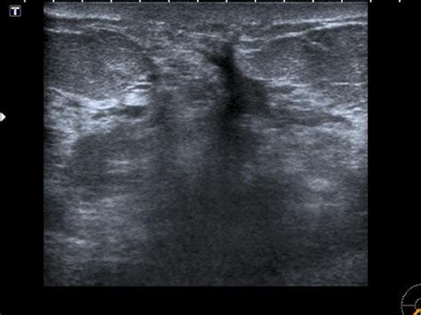 Figure 6 From Ultrasound Of Non Neoplastic Breast Lesions With