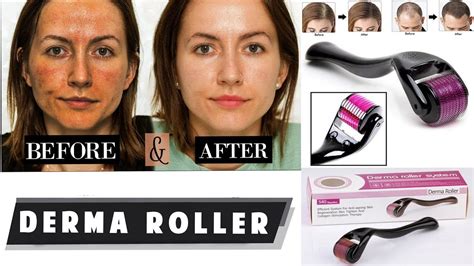 How To Use Derma Roller Hair Growth Wrinkles Review Before After
