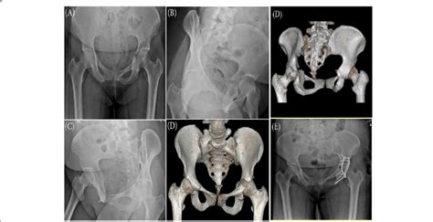 Plain Radiographs A Anteroposterior B Iliac Oblique View C