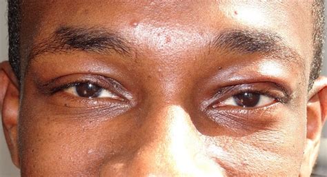 Blepharochalasis Syndrome Eyewiki