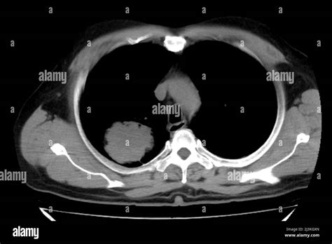 Lung Carcinoma Chest Ct Scan Stock Photo Alamy
