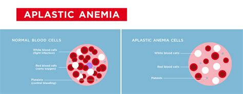 Aplastic Anemia Causes Signs Symptoms Life Expectancy Treatment