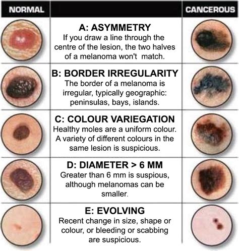 The Abcdes Of Melanoma Saguaro Dermatology Images And Photos Finder