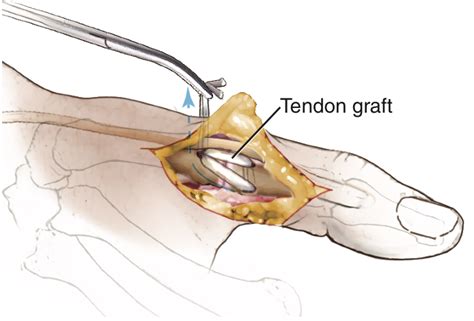 Wrist — landing on an outstretched hand during a fall Thumb MCP Joint Ulnar Collateral Ligament Reconstruction - Thomas R. Hunt III, M.D., D.Sc.