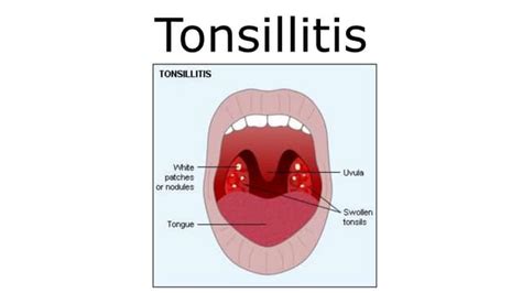 Tonsillitis And Adenoids Causes Symptoms Treatment Ppt